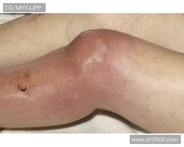 足球球星膝盖积液原因分析与康复治疗方法探讨